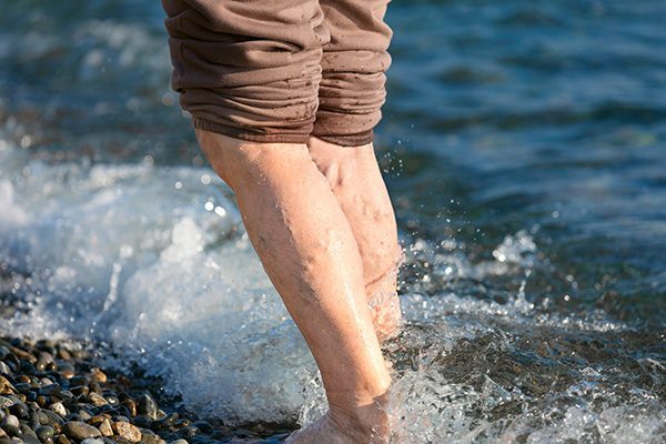 Venenpatient mit Krampfadern vor einer Venen OP im Urlaub am Meer